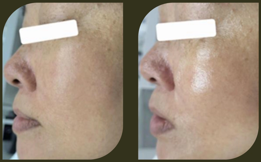 DEP 無針注射水光