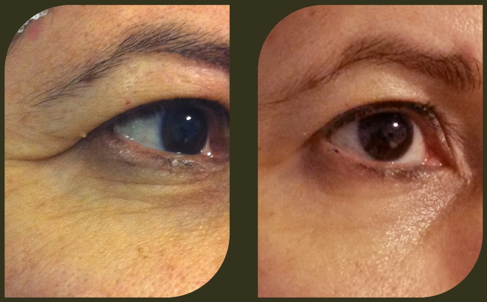 DEP 無針注射水光