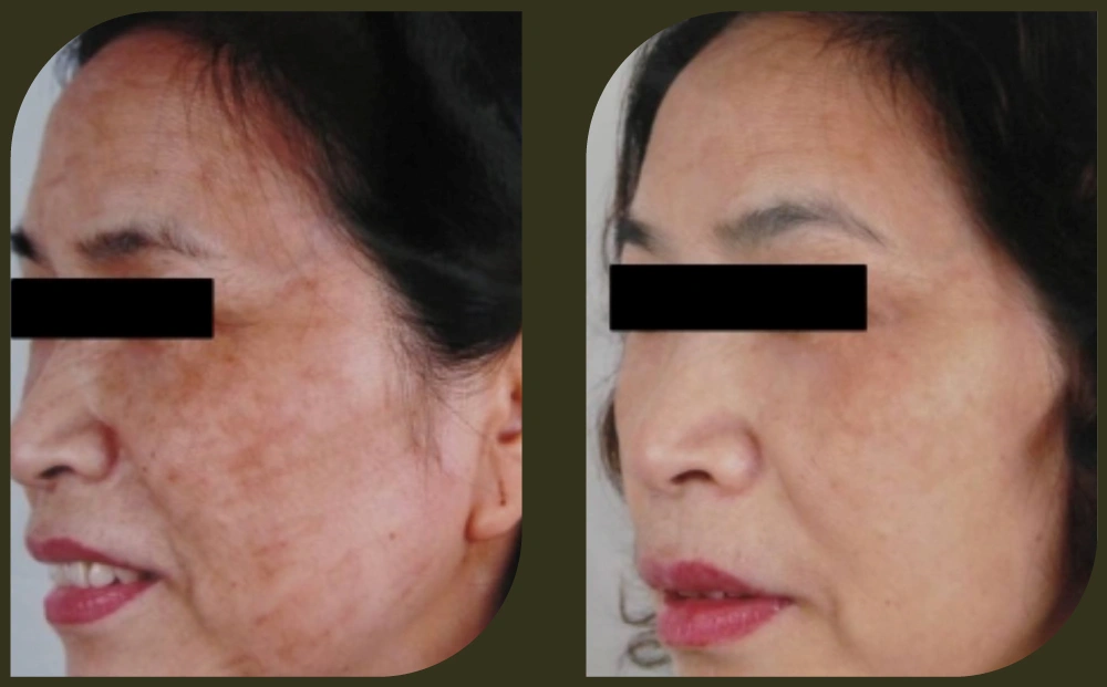 DEP 無針注射水光