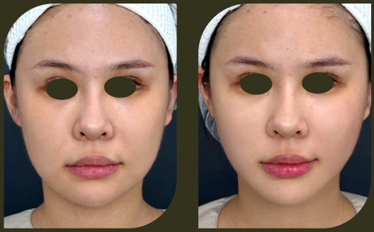 ultherapy