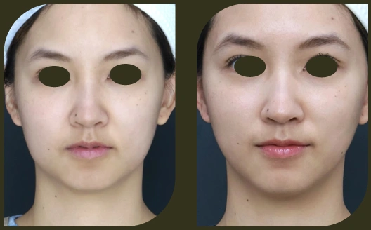 ultherapy