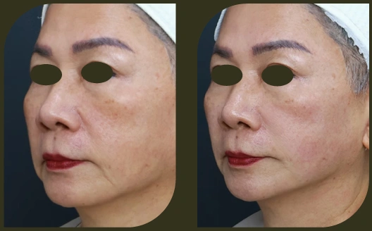 ultherapy