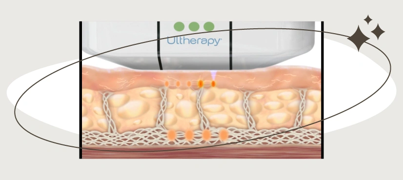 Ultherapy