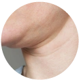 Ultherapy