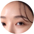 Ultherapy